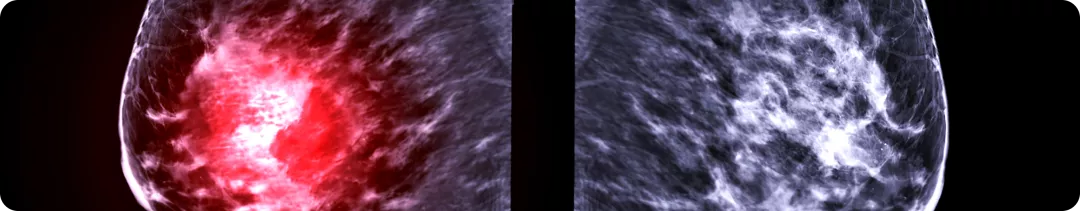 Что такое система BI-RADS и зачем о ней знать клиницисту