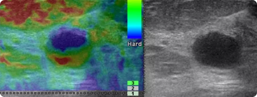 Эластография/эластометрия
