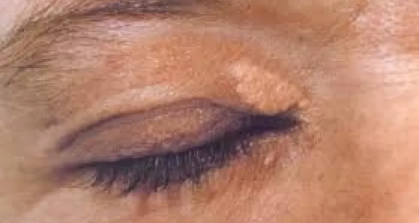 сухожильные ксантомы