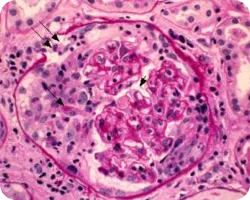 Клеточные или&nbsp;фиброзно-клеточные полулуния