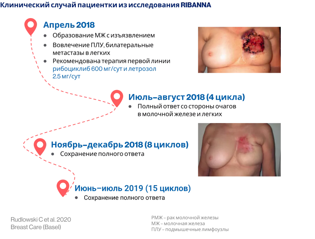 Рибоциклиб эффективен для лечения местнораспространенного РМЖ Клинический случай пациентки из исследования RIBANNA