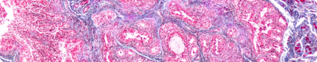 RECIST 1.1 (Response Evaluation Criteria In Solid Tumors) — критерии оценки ответа солидных опухолей