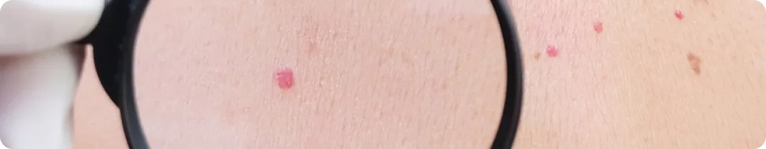 Ожидания vs реальность: триплет в лечении BRAF+ метастатической меланомы