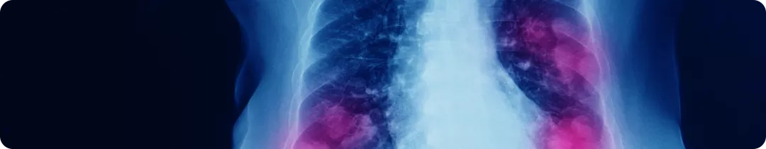 Роль метода NGS в поиске нарушений в гене МЕТ при НМРЛ