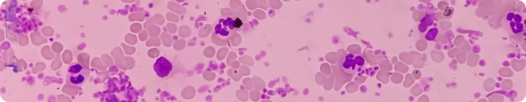 Определение, распространенность и клиническая картина эссенциальной тромбоцитемии