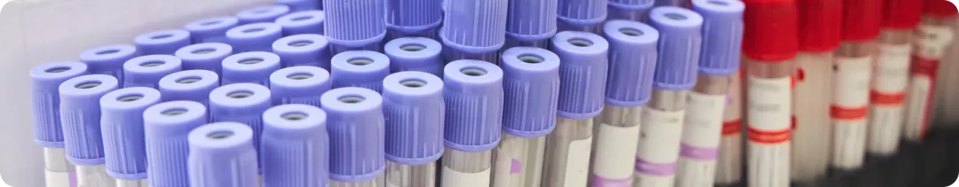 Диагностика липопротеина(а)