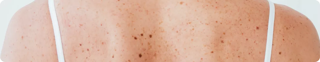 Изменение BRAF-статуса при меланоме кожи — правда или миф?