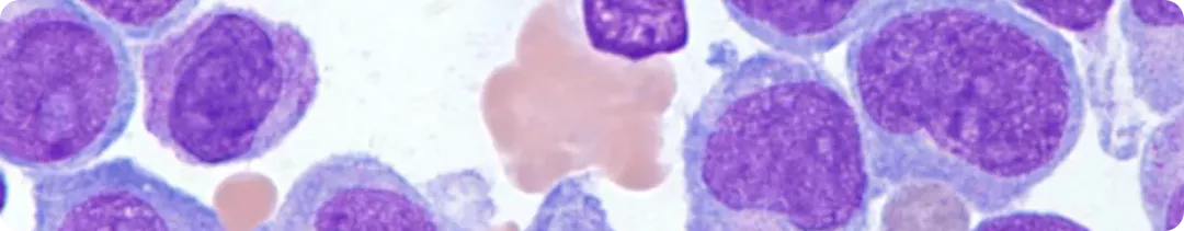 Острый миелоидный лейкоз