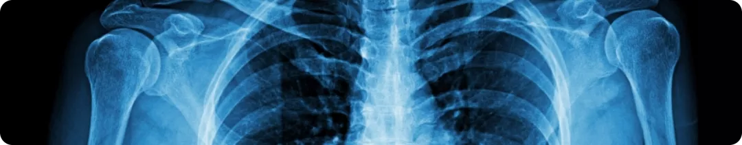 Можно ли выявить ПсА вовремя: основные предикторы прогрессирования поражения суставов Василенко А.А.