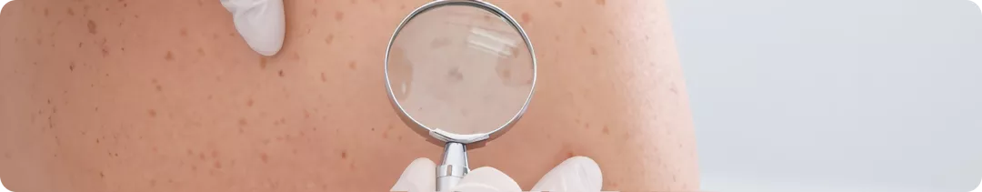 Первая линия терапии BRAF+ меланомы кожи: от клинических данных к осознанному выбору