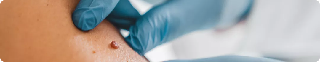 Как правильно выбрать адъювантную терапию BRAF+ меланомы кожи?