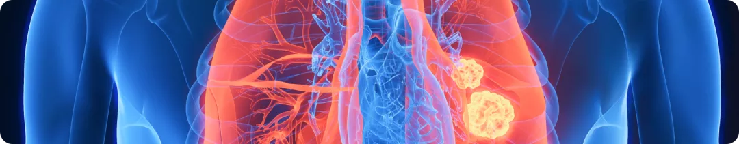 Разговор с экспертом. Скрининг и диагностика рака легкого