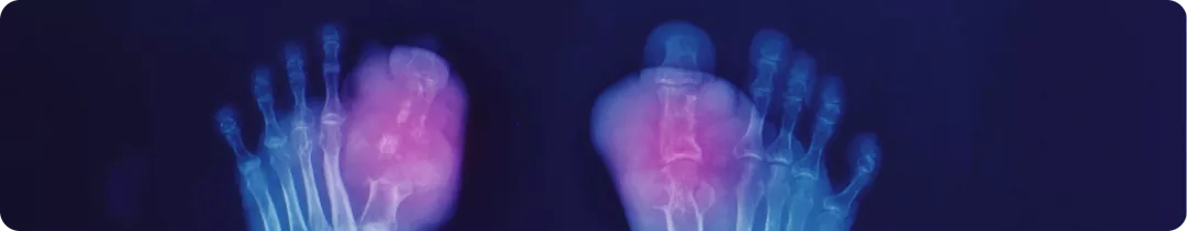 Подагра. Общая информация о заболевании