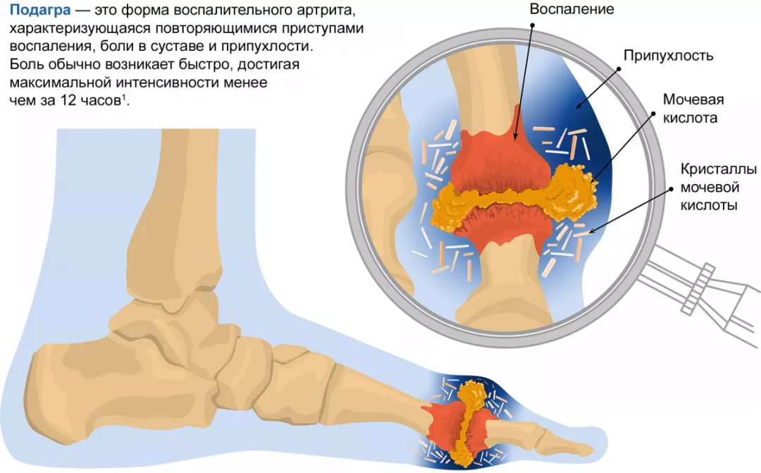Отложение кристаллов моноурата натрия в области 1-го плюснефалангового сустава
