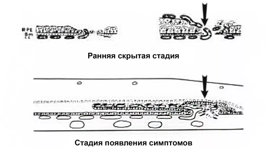 ХНВ 2 типа: черные стрелки показывают рост новых капилляров из хориокапилляров через дефект в локально поврежденной мембране Бруха в пространство под нейроэпителием вдоль участка пролиферирующего   