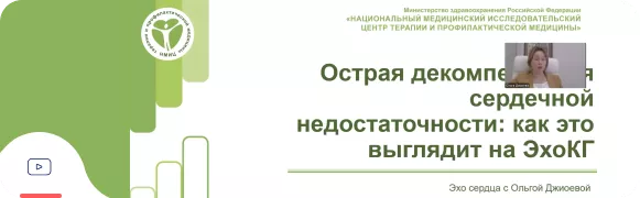 ОДСН на ЭхоКГ