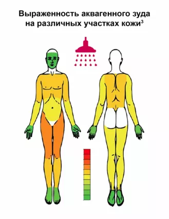 Аквагенный зуд