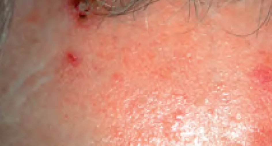 Актинический кератоз