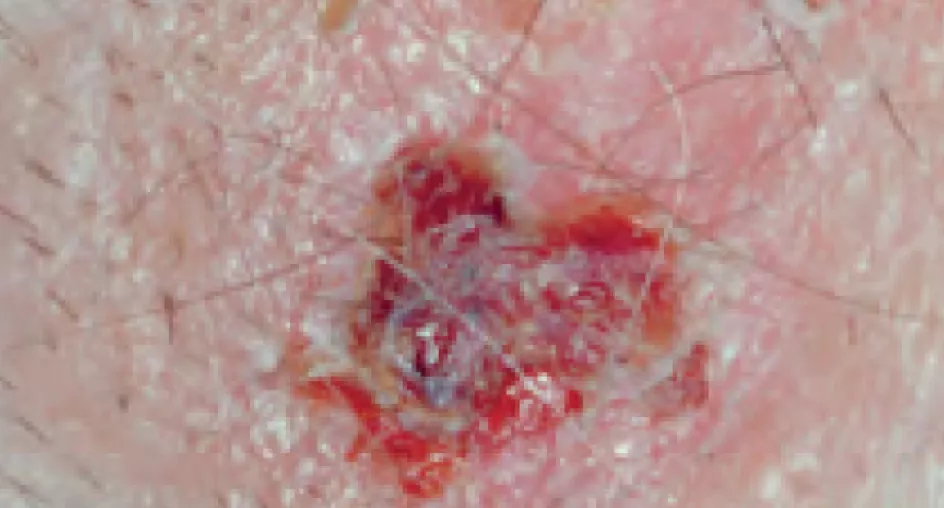 Базальноклеточный рак