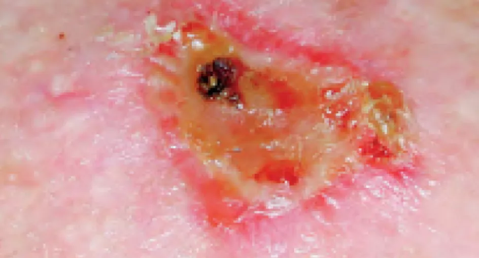 Плоскоклеточная карцинома