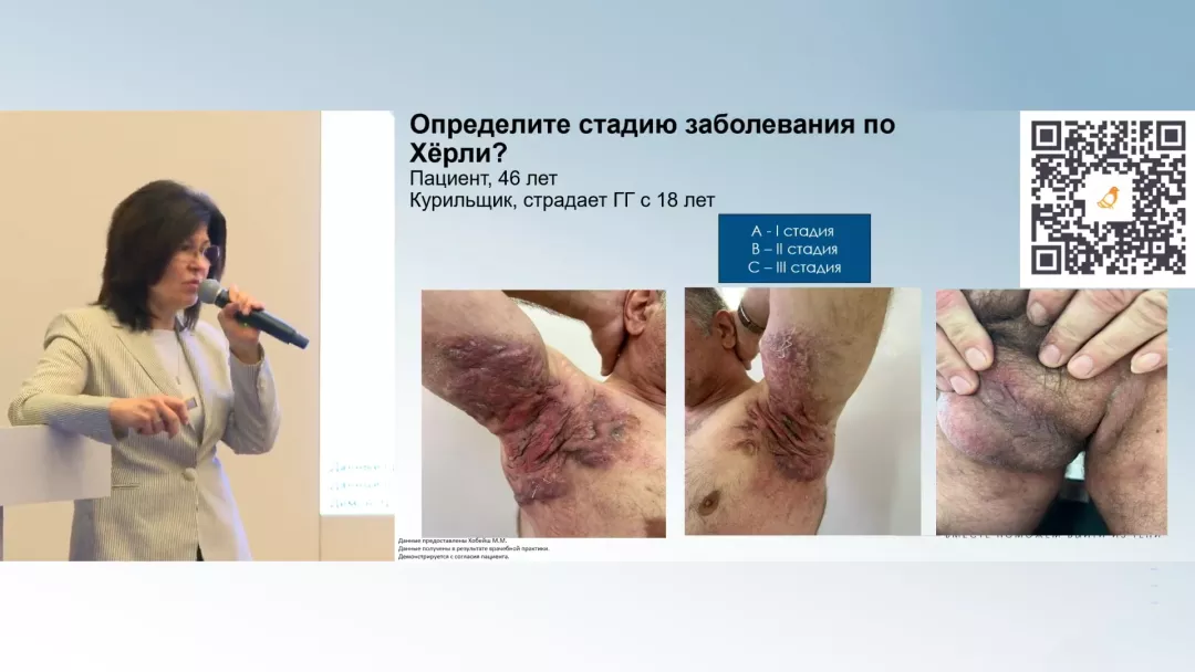 Клинический случай пациента с гнойным гидраденитом