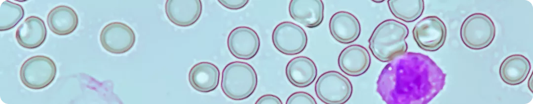 Критерии диагностики и степени тяжести апластической анемии