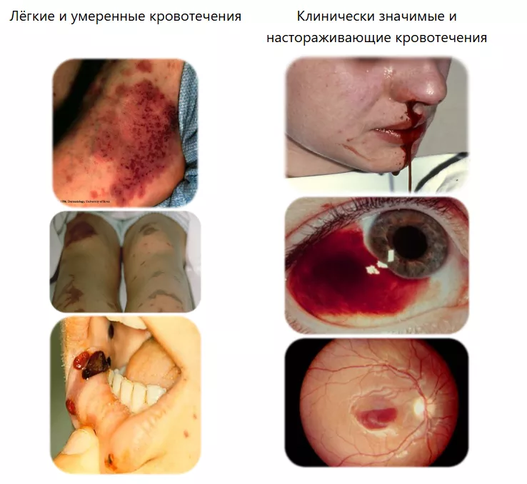 Легкие и умеренные кровотечения