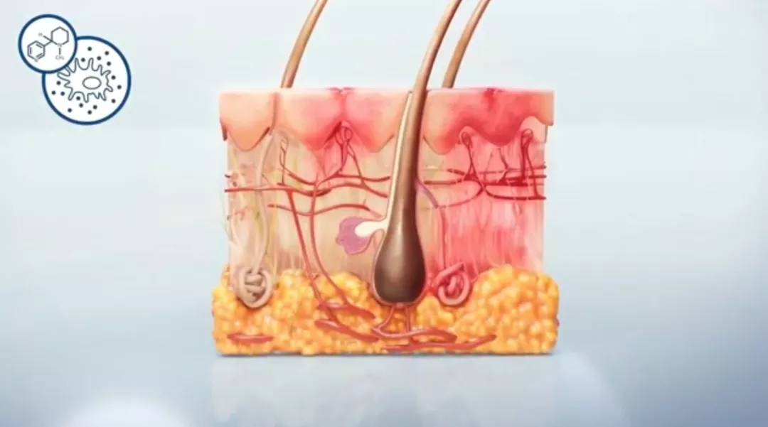 Патогенез суппуративного гидраденита: переход в распространенную стадию Патогенез суппуративного гидраденита: переход в распространенную стадию