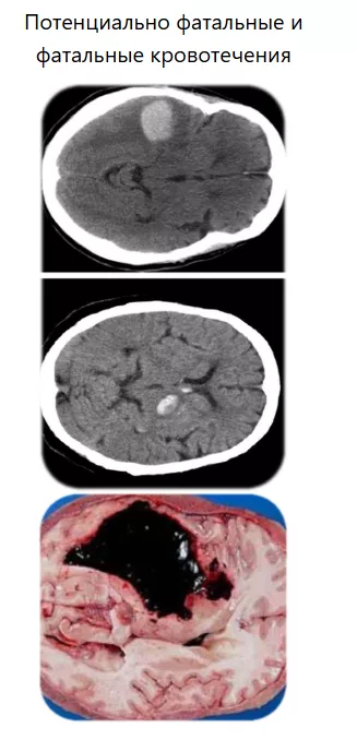 Потенциально фатальные и фатальные кровотечения