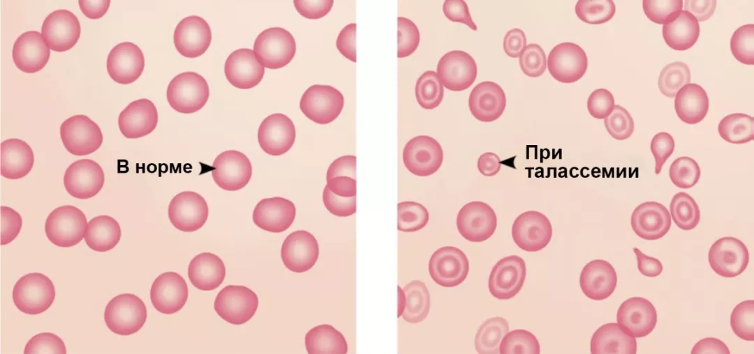 Рисунок 3. Эритроциты в норме и при талассемии