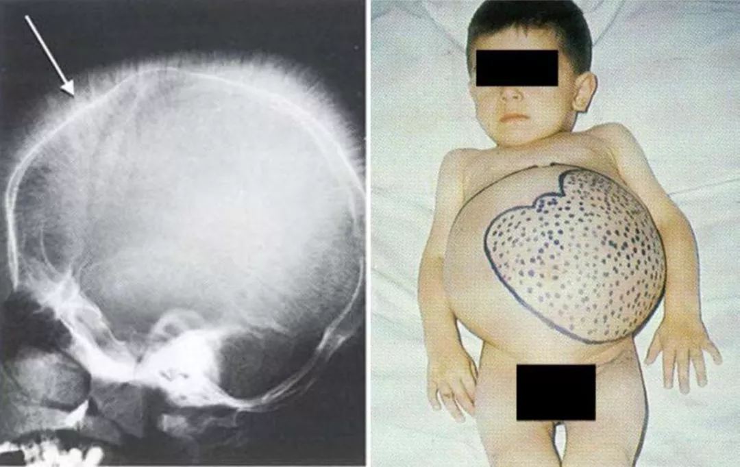 Рисунок 6. Клинические проявления β-талассемии