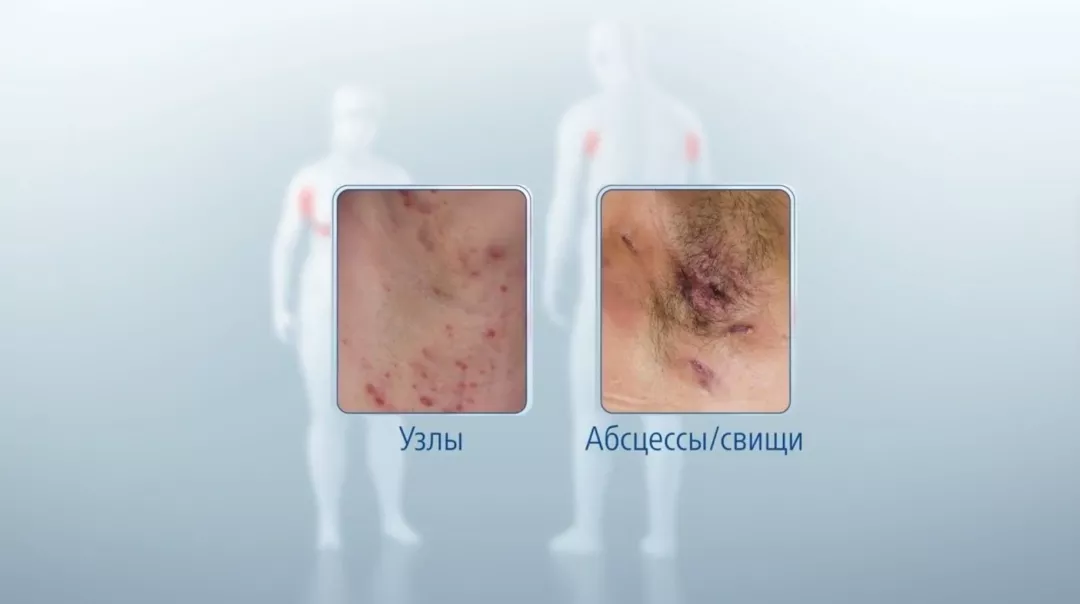 Суппуративный (гнойный) гидраденит Суппуративный (гнойный) гидраденит