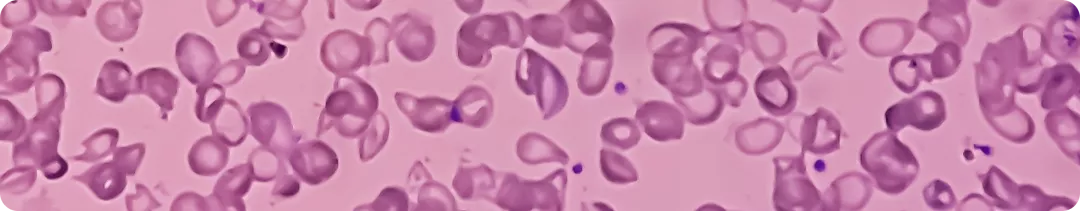 Элтромбопаг в терапии рефрактерной ТАА