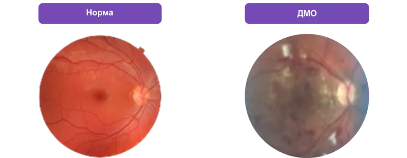 Исследование глазного дна при офтальмоскопии (норма и ДМО)