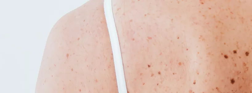 Изменение BRAF-статуса при меланоме кожи — правда или миф?