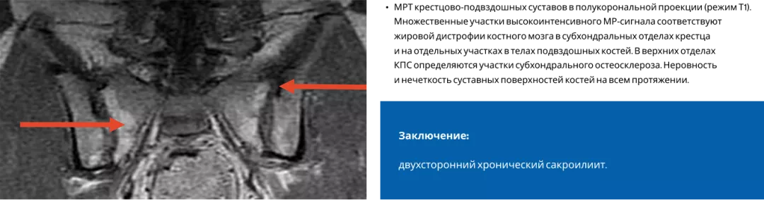  МРТ крестцово-подвздошных суставов