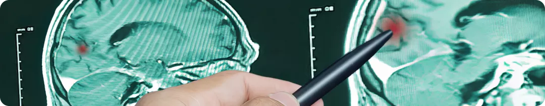 Метастатическое поражение головного мозга при меланоме кожи