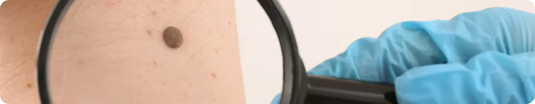 С чего начинать терапию метастатической меланомы кожи? ASCO 2022: данные реальной клинической практики