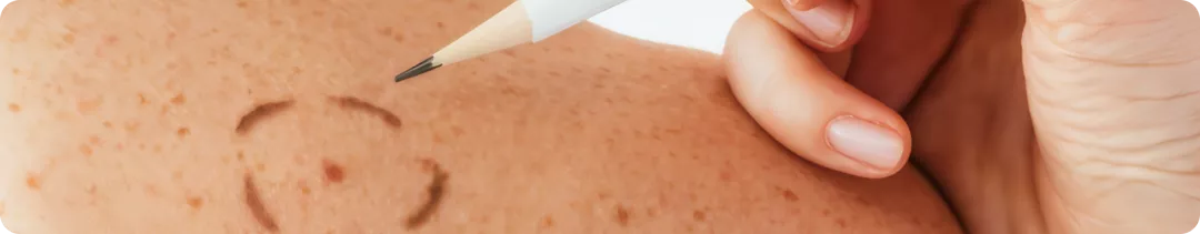 Тройная комбинация – оправдала ли ожидания новая схема лечения метастатической меланомы кожи?