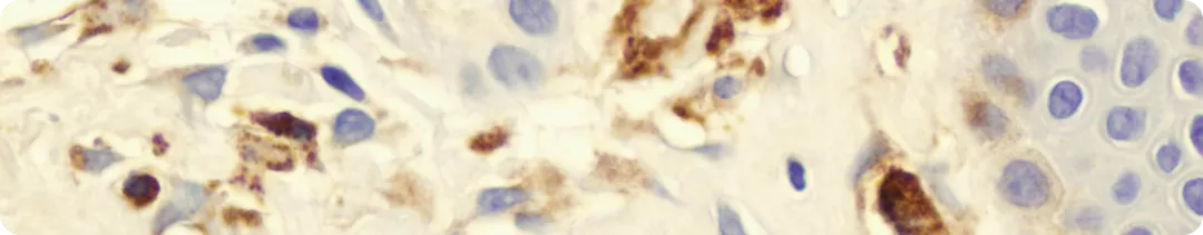 Системный мастоцитоз