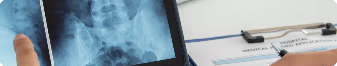 Клинический случай длительного ответа при возврате к таргетной терапии при метастатической меланоме кожи