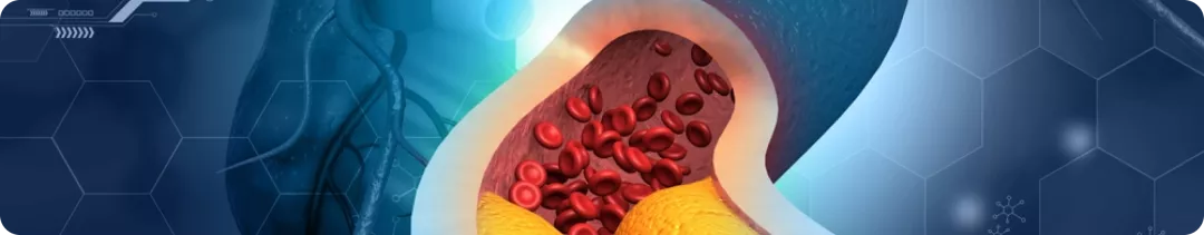 Атеросклероз