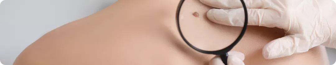 Факторы риска развития меланомы