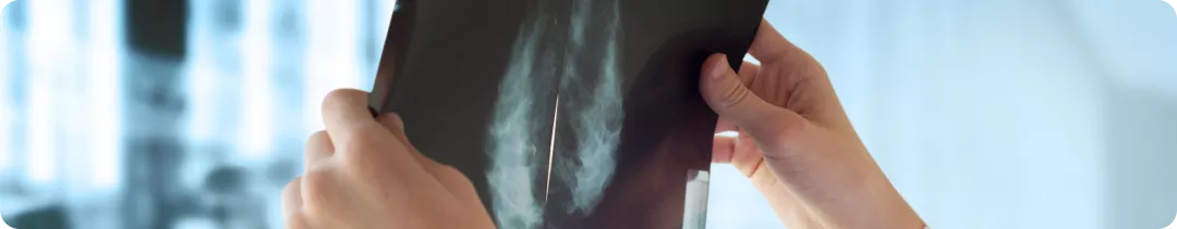 Частота развития рецидивов у пациентов с ранним РМЖ