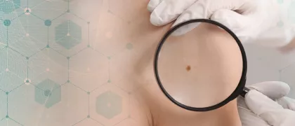 Исследование Rationale: результаты адъювантной таргетной терапии при меланоме кожи в России