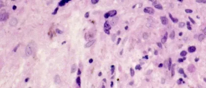 Миелофиброз, риск-адаптированная терапия