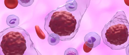 Обновление национальных клинических рекомендаций по диагностике и лечению Ph-негативных миелопролиферативных новообразований