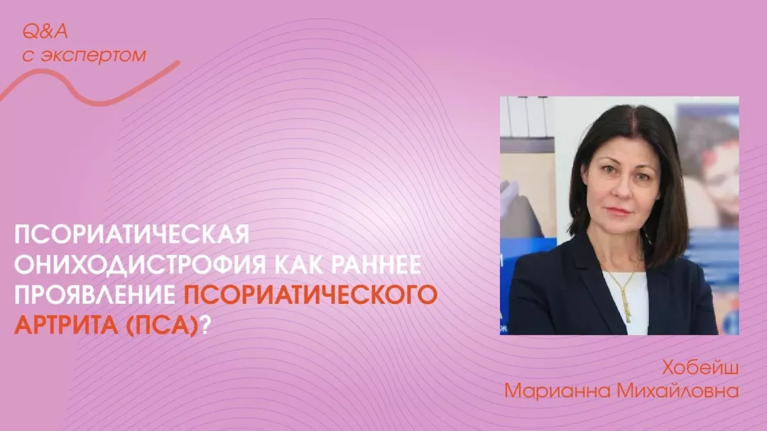 Псориатическая ониходистрофия как раннее проявление псориатического артрита (ПсА)