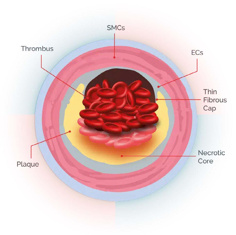 novartis_lp-a_onepager4_digitala4_250430_korr.jpeg novartis_lp-a_onepager4_digitala4_250430_korr.jpeg