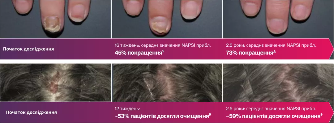 Потужний у ділянках з постійним ураженням